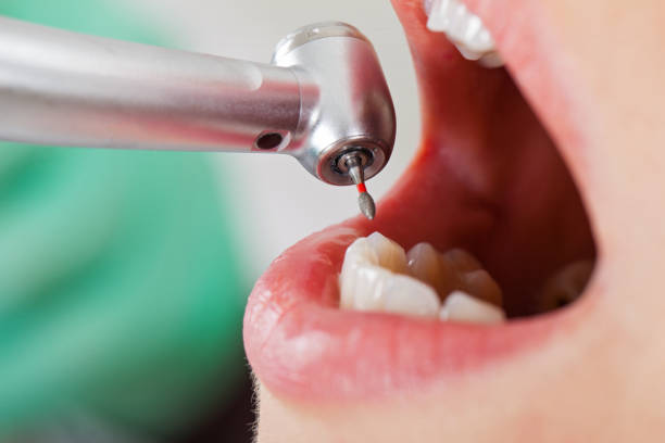 Best Emergency Wisdom Tooth Extraction in Blandon, PA
